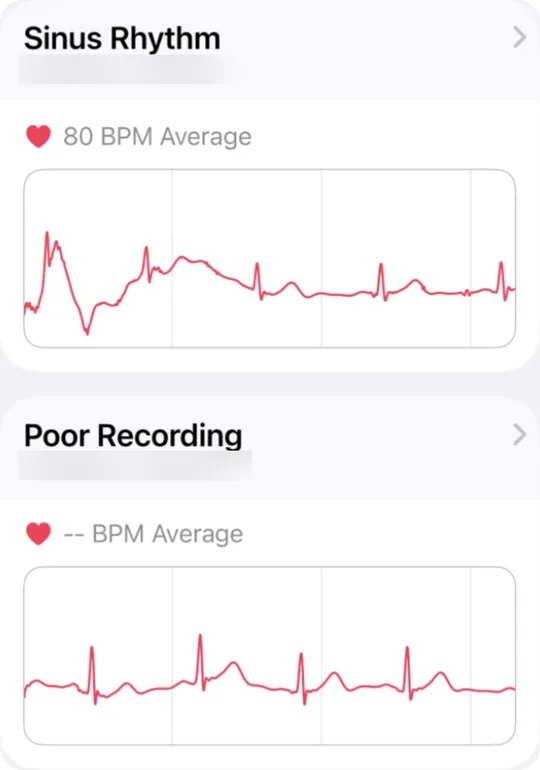 Two Apple Watch ECG recordings made the same evening. One is labeled sinus rhythm and the other poor recording.